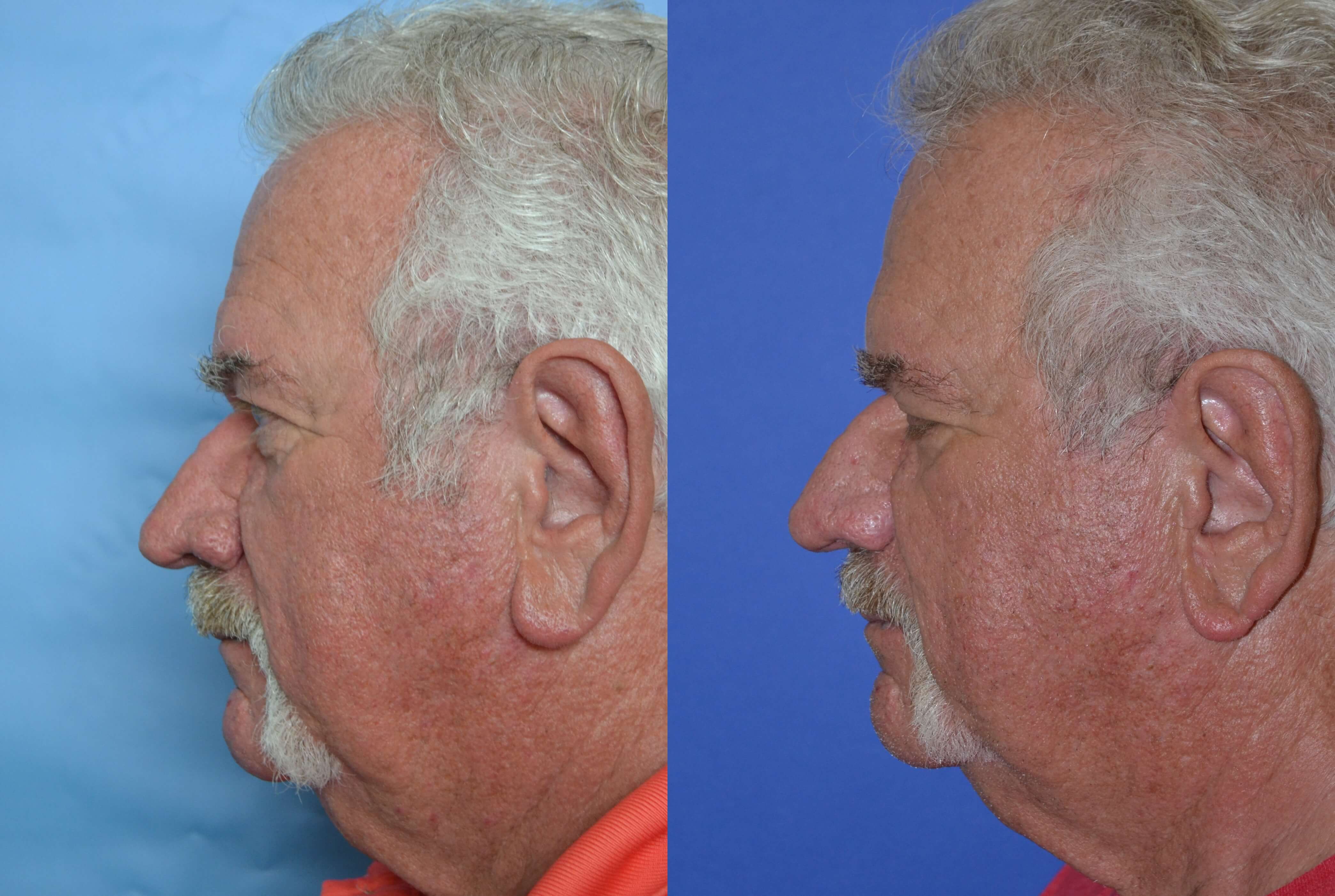 Rhinophyma Photos Melbourne, FL Patient 27706